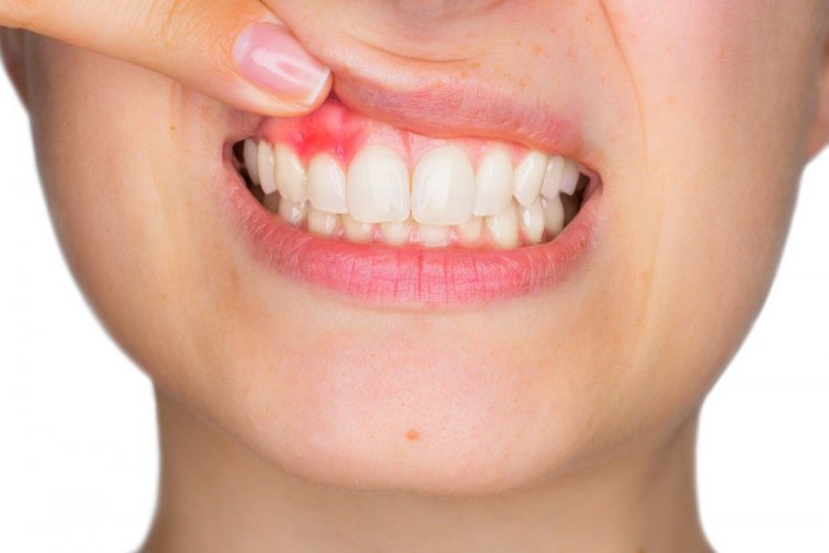दांतों का दर्द दूर करने के घरेलू उपचार | Home Remedies For Teeth Pain in hindi