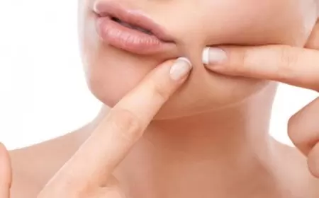 मुँहासे हटाने के लिए घरेलु उपाय | Pimples Hatane ke gharelu upay in hindi