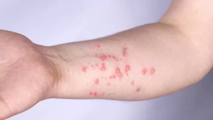 मंकीपॉक्स : क्या हैं लक्षण और कैसे फैलती है यह बीमारी? | monkeypox kya hai in hindi