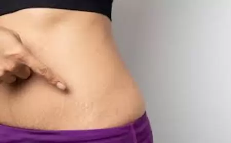 स्ट्रेच मार्क्स या खिंचाव के निशान हटाने के उपाय | Stretch marks hatane ke upay in hindi