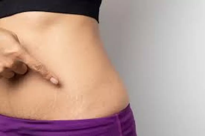 स्ट्रेच मार्क्स या खिंचाव के निशान हटाने के उपाय | Stretch marks hatane ke upay in hindi