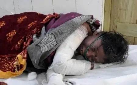 Jamshedpur Fire Accident: आग तापते समय महिला बुरी तरह झुलसी, अस्पताल में जिंदगी की जंग जारी